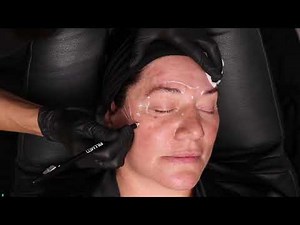 Basic guidelines for beginners on cheek fillers/ augmentation