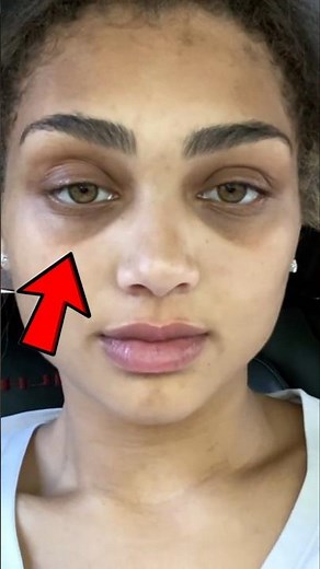 Raccoon Eyes: What They Mean & When to Worry! 🦝😨