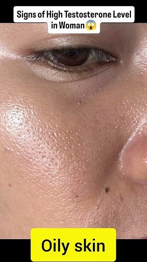 Signs of High Testosterone in Women 🚨