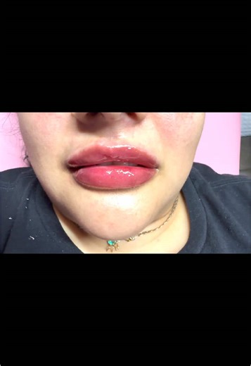 ✨ Another Satisfied Customer! ✨ Another gorgeous transformation at Luxe Lush Inc! Our client left feeling confident and absolutely in love with her new lips. 💋✨ 📸 Before & After: (Insert photo) 💬 Her words: “I’m obsessed! The shape, the volume—everything is perfect! Thank you, Luxe Lush Inc!” Ready for your own glow-up? Book your appointment today! 💛🖤🤍 📍 Dallas, Tx 📅 Appointments: www.vagaro.com/luxelushinc 📲 Call/Text: (713)-815-1903 #LuxeLushInc #LipFiller #LipGoals #DallasBeauty #Plu