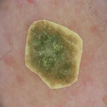 Skin lesion Segmentation using Multi-scale Features and Channel Attention Mechanism