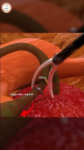 Laparoscopic Gallbladder Removal | Cholecystectomy Procedure | 3D Medical Animation