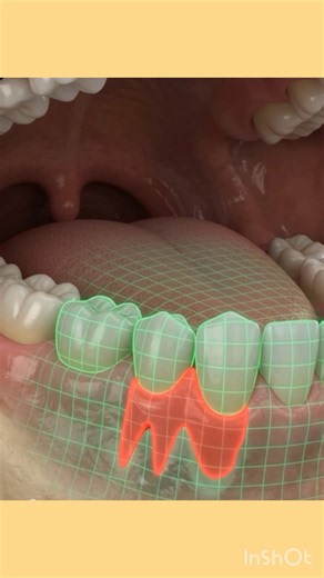 #Alveoloplasty#