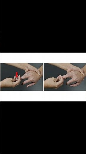 Hoffman Sign Explained #neurology #chiropractor #physio #ATC #meded