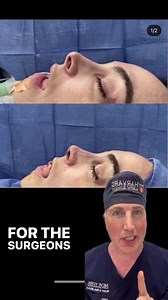 Alar retraction in revision rhinoplasty