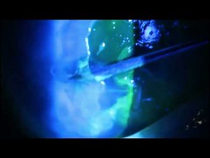 Cornea Debriding and Amnion Stem Cells to treat EBMD / Map Dot Dystrophy