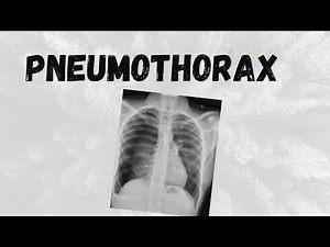 Understanding Pneumothorax: Causes, Symptoms, and Treatment Explained