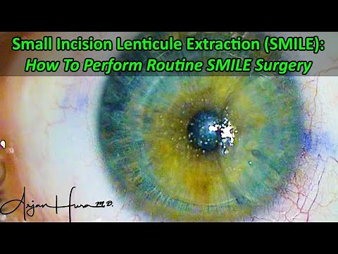 How To Perform SMILE Laser Eye Surgery