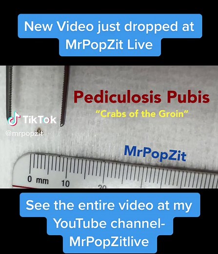 You can see the whole story at my YouTube channel - mrpopzitlive this patient was misdiagnosed with eczema, but asking the right questions and doing a thorough exam got me to the correct diagnosis. #dermatology #physicianassistant #dermatologypa #mrpopzit #mrpopzitlive #medicaleducation #youtuber #youtube #bodylice #pubiclice #crabs