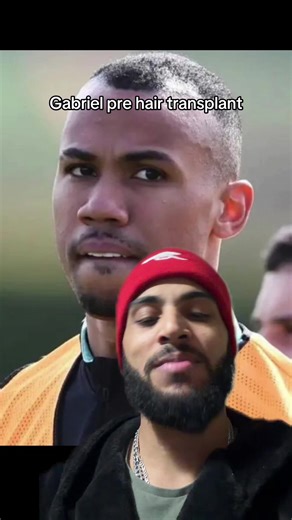Tell me im wrong #hairtransplantation #gabriel #arsenal #football #beast
