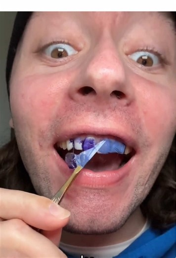 Why don't you try this whitening tooth patch? Use it once a day for 30 minutes.#Tooth paste#Teeth whitening patch#Toiletries#Whitening of yellow teeth