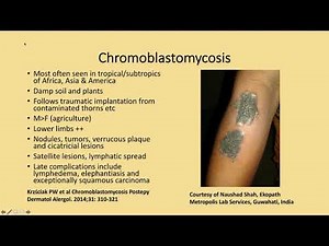 Chromoblastomycosis Phillip H McKee
