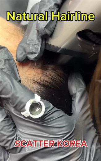 이헌정 on Instagram: "Say goodbye to high hairline! Experience the Scatter magic #SMP #HairlineTattoo #ScalpMicropigmentation #ScatterMachine #HairlossSolution #BeautyTech #HairlineRestoration"