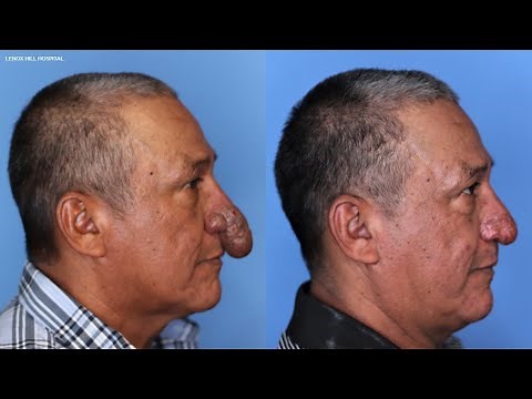 Plastic surgeon offers painter life-changing surgery on nose deformity