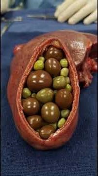 Gallstones Explained: How They Form and Cause Severe Pain | 3D Medical Animation