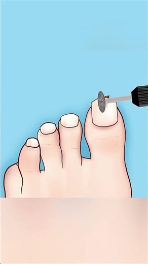 How to Remove a Wood Splinter from Under Your Nail Safely 🩹