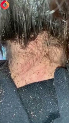 Hairdresser shares horrific LICE INFESTATION on girl's head that took NINE HOURS to remove