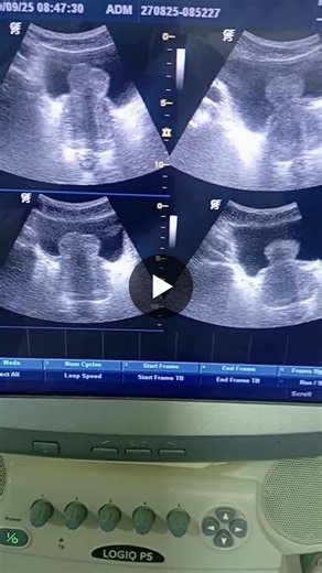 Understanding Intravesical Prostatic Protrusion Symptoms and Diagnosis | George Attah Gyimah posted on the topic | LinkedIn