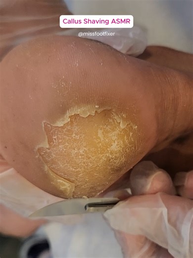 Effective Callus Removal for Soft, Smooth Feet