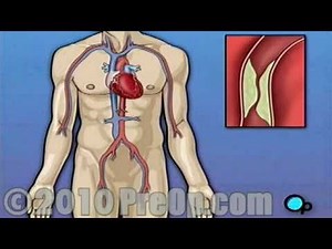 Coronary Artery Bypass Graft (CABG off-pump) PreOp® Patient Education