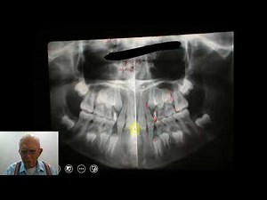 Second Molar Extraction Cases