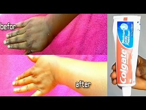 OMG!! I APPLY TOOTHPASTE ON MY SKIN SEE WHAT HAPPEN TO MY SKIN THE RESULT IS AMAZING