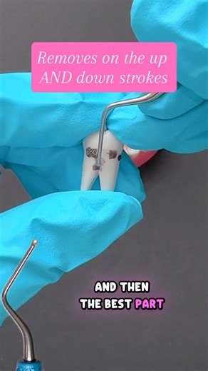 HYGIENE edgeUCATORS on Instagram: "Furcations are some of the most challenging areas to access during periodontal therapy. The O’Hehir New Millennium™ 9–10 from @pdtdental is designed with a scooped concave blade that offers 270° cutting edge perimeter, allowing clinicians to adapt to complex root anatomy with minimal tissue trauma. Its rounded back facilitates subgingival insertion without distending the sulcus, while the pull or push stroke enables thorough debridement from both buccal and lin