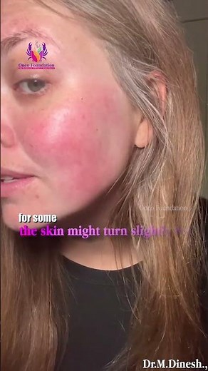 Does Radiation Therapy Cause Permanent Skin Scars? | Myth vs Fact