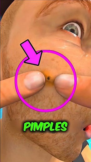 What Really Happens When You Pop a Pimple? (It’s Worse Than You Think)