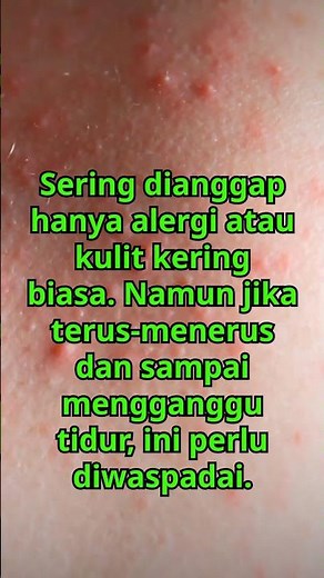 **Gatal Tanpa Ruam: Tanda Serius?**