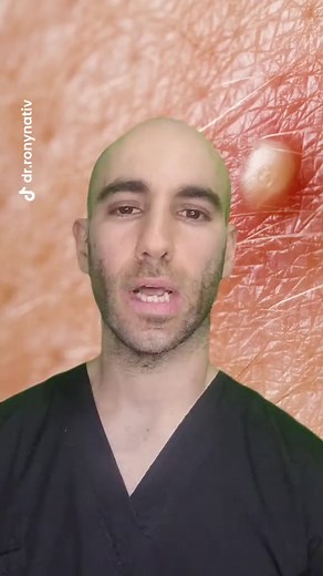 Consejos para el Tratamiento de Forúnculos