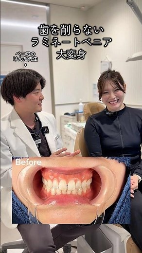 歯を削らないラミネートベニア💎🦷歯の表面に薄いセラミックを貼る治療です🙂‍↕️✨ #審美歯科 #ラミネートベニア