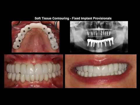 Dental Implant Full Mouth Rehabilitation