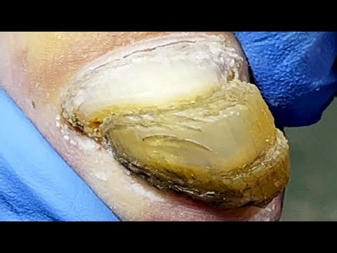 Fat Toenails, Getting Cleaner Little By Little【Pedicure King】