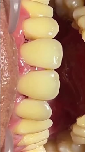 Composite Bonding for Perfect Teeth with Dr. John