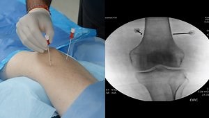 Needle and Electrode Placement for Radiofrequency Ablation of the Knee