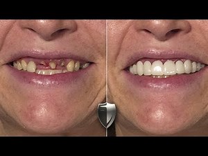 Brighter Image Lab - Fear of Dentist! See Incredible Smile Makeover in 1Minute! No Dentist Veneers