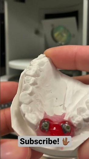 Splinting implant impression copings: How to do it!