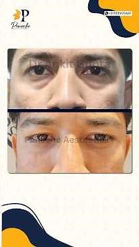 Blepharoplasty Patient Review | Swelling, Recovery & Experience | Eyelid Surgery Testimonial |