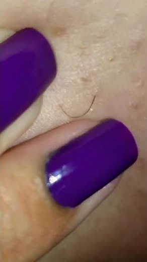 Months old ingrow from groin