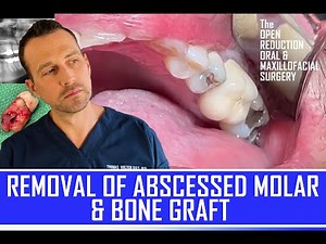 MOLAR with an ABSCESS | EXTRACTION & BONE GRAFT