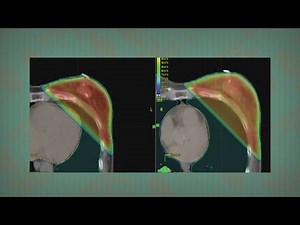 Living Healthy: Left Breast Cancer Treatment
