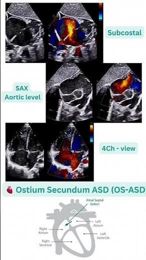 Ostium Secundum ASD (OS-ASD) #ASD #EchoDxHub #CongenitalHeartDisease #echocardiography #2decho