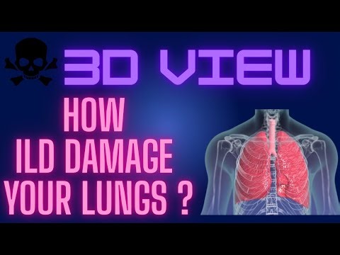 Interstitial Lung Disease (ILD) - Classification, pathophysiology, signs and symptoms I Biovision3D