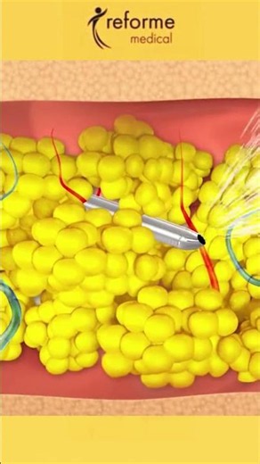 How does liposuction work? Best BodyTite Liposuction #cosmeticsurgery