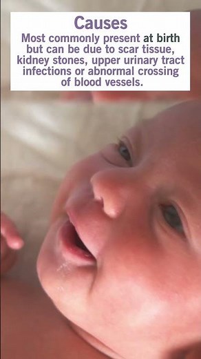 3 Must-Knows about Uretero-pelvic junction (UPJ) obstruction & Pyeloplasty