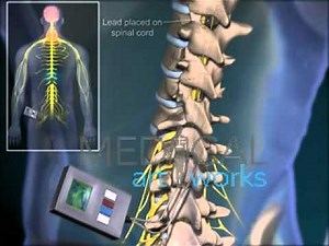 3D Medical Animation | Spinal stimulator surgery