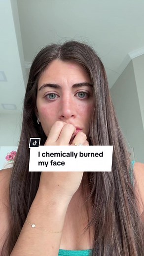 Someone pls help me what did i do and how do i fix it????? #chemicalburn #chemicalburns #tretinoin #retinolskincare #retinoids #dermatology #skincarehelp #tretinoincream #tretinoinburn #dermatologist