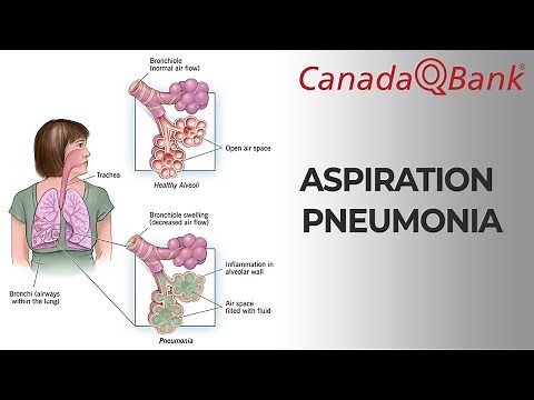 Aspiration Pneumonia