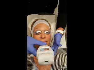 Full Face Intense Pulse Light (IPL) Laser Treatment